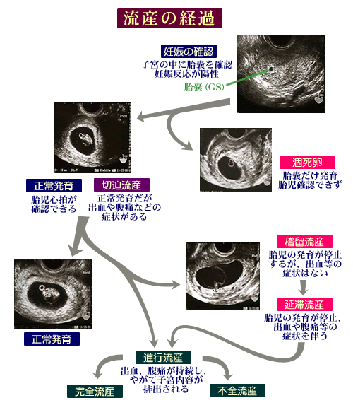 流産 繋留 繋留（稽留）流産の症状や兆候。心拍確認できず発見されるのが大半！