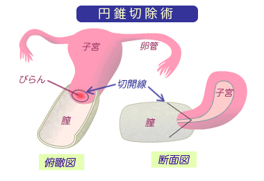 ブログ 円錐 切除