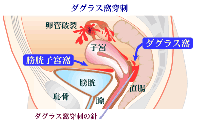 子宮 外 妊娠 つわり