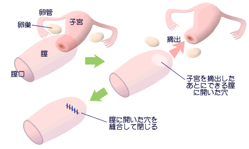 子宮 全 摘 開腹 手術 後 お腹 が 張る