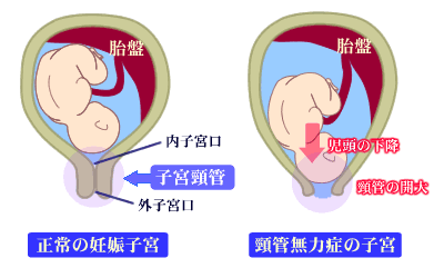 無力 症 頸管 症状 子宮 子宮頸管無力症の原因と改善方法 手術しなくても治るのか？