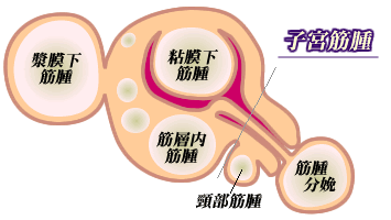 中 子宮 筋腫 妊娠