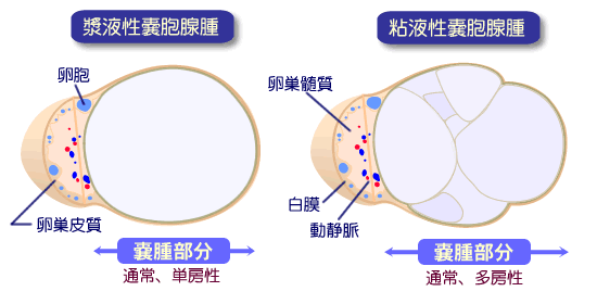 奇形 腫 卵巣